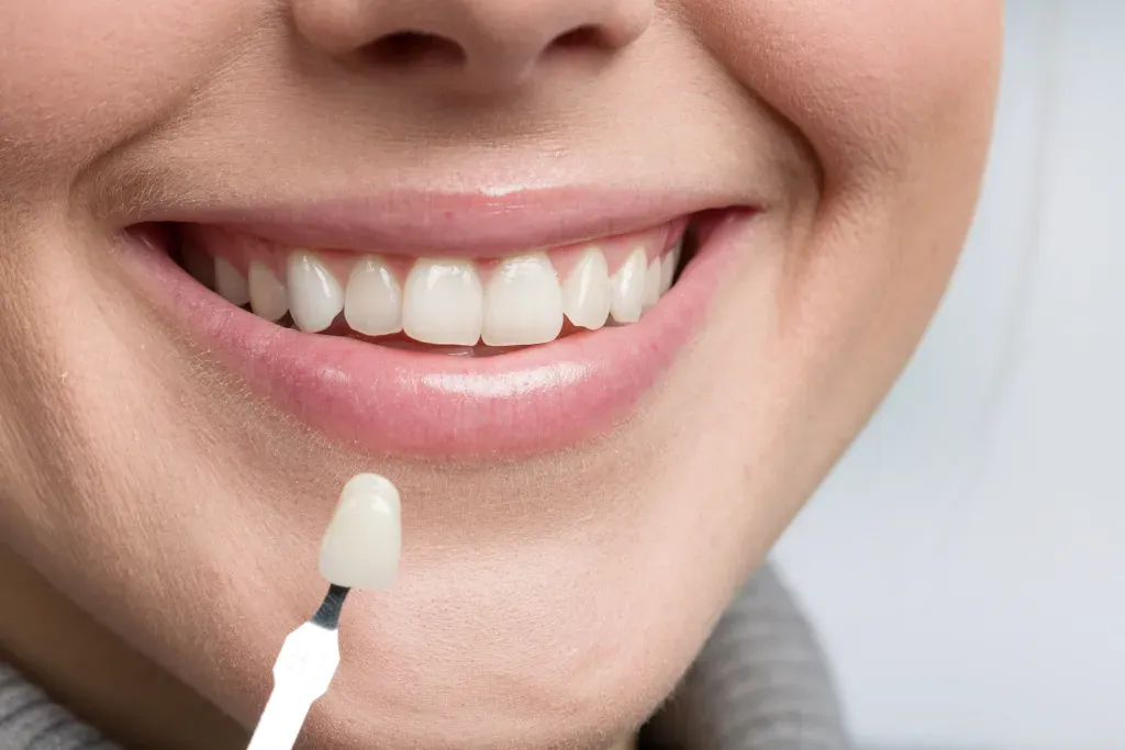 Porcelain Veneers Explained